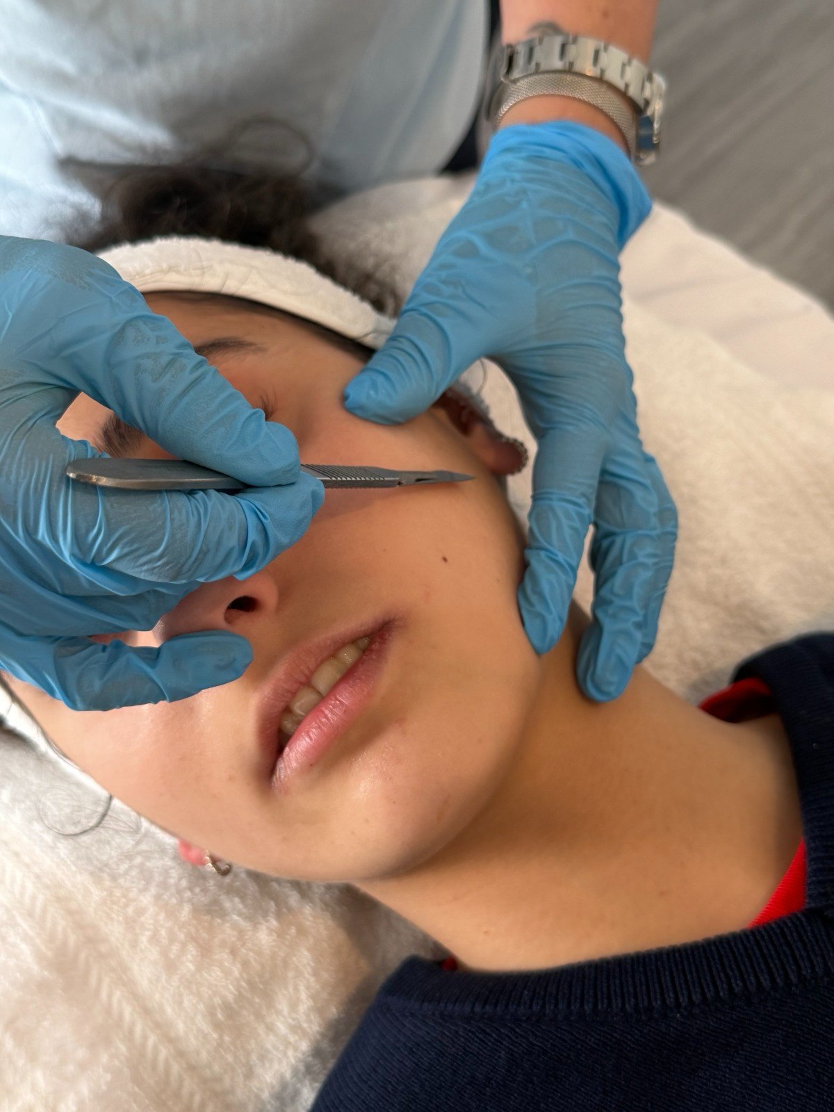 Dermaplaning